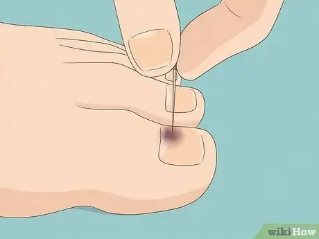 Image intitulée Remove a Dead Toenail Step 4