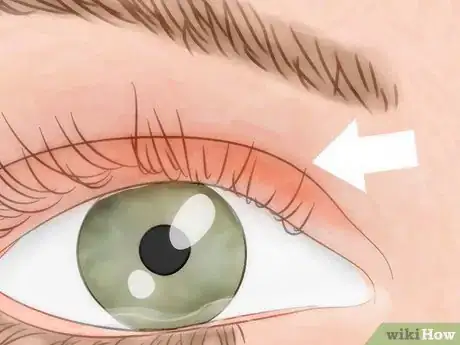 Image intitulée Know if You Have Eye Mites Step 3