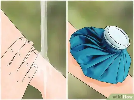 Image intitulée Identify and Treat Black Widow Spider Bites Step 4
