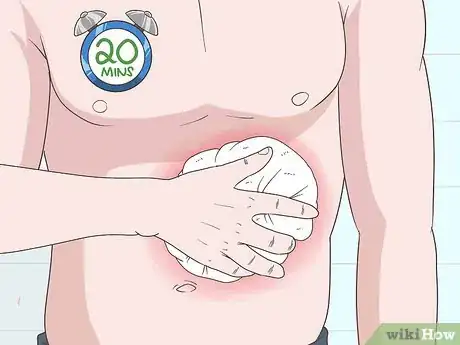 Image intitulée Treat an Ice Burn Step 6