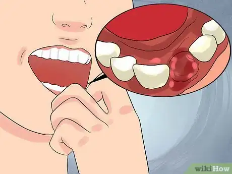 Image intitulée Deal With a Tooth Pulling Step 11