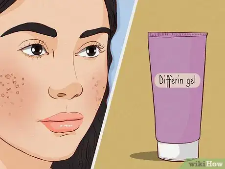 Image intitulée Get Rid of Acne Redness Step 8