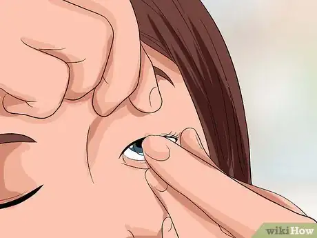 Image intitulée Remove Stuck Contact Lenses Step 12