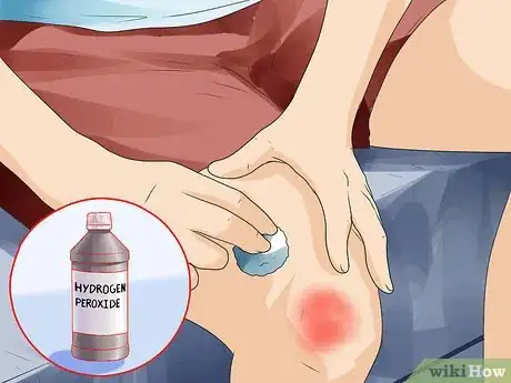 Image intitulée Treat Carpet Burns Step 3
