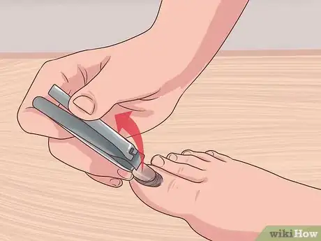 Image intitulée Treat a Torn Toenail Step 1