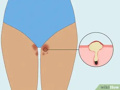 Image intitulée Get Rid of a Rash Between Your Legs Step 11