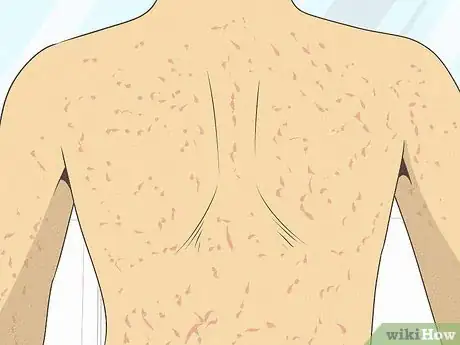 Image intitulée Differentiate Bacterial Tonsillitis and Viral Tonsillitis Step 11