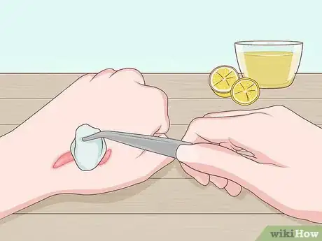 Image intitulée Get Rid of Keloids Step 10