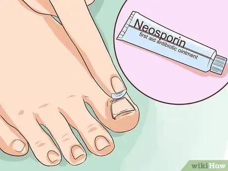 Image intitulée Treat a Torn Toenail Step 4