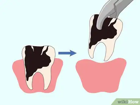 Image intitulée Cure a Toothache Step 9