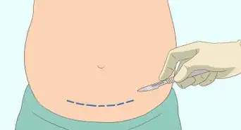 savoir si l’on est enceinte quand on souffre du syndrome des ovaires polykystiques