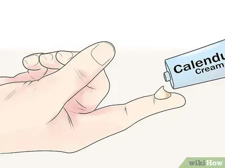 Image intitulée Kill Scabies At Home Step 7