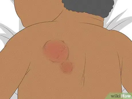 Image intitulée Know What to Expect on a Newborn's Skin Step 19