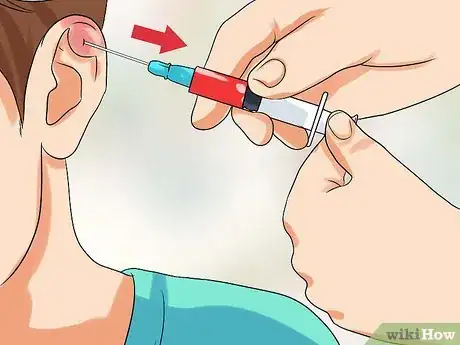Image intitulée Drain Cauliflower Ear Step 8