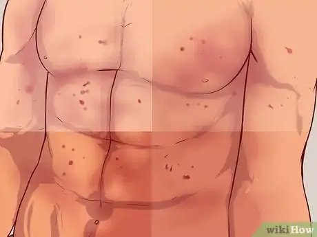Image intitulée Recognize Radiation Sickness Step 3
