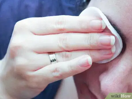 Image intitulée Treat Seborrheic Dermatitis Step 12
