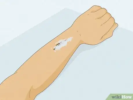 Image intitulée Remove Sharpie Ink from Skin Step 7