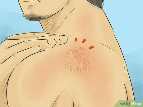 Image intitulée Treat a Sunburn Step 19