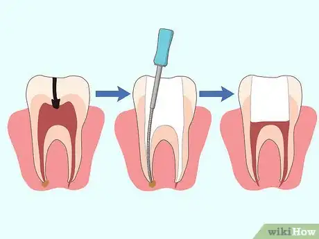 Image intitulée Cure a Toothache Step 8