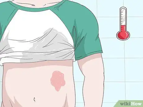 Image intitulée Treat an Ice Burn Step 1