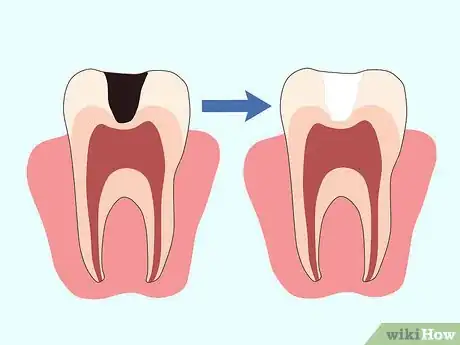 Image intitulée Cure a Toothache Step 7