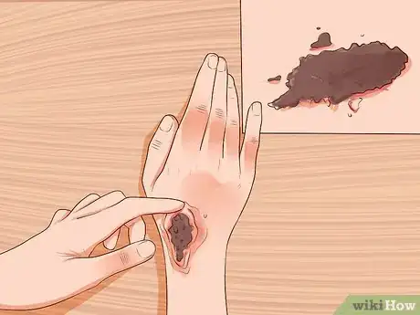 Image intitulée Treat a Facial Burn from a Curling Iron to Prevent Scars Step 11