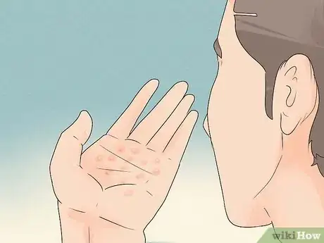 Image intitulée Treat Eczema Naturally Step 22
