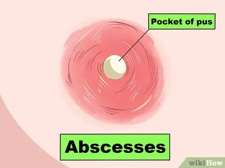Image intitulée Recognize Staph Infection Symptoms Step 2