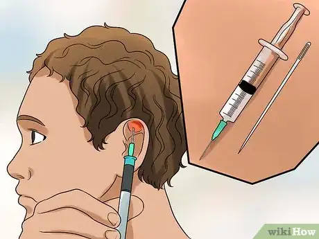 Image intitulée Drain Cauliflower Ear Step 7