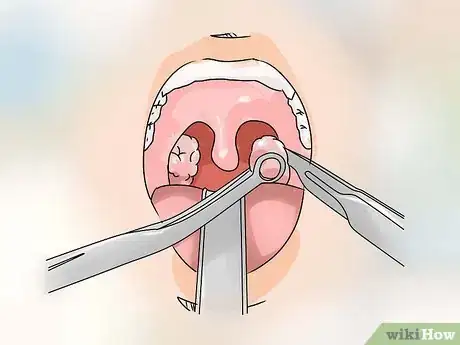 Image intitulée Treat Tonsillitis Step 11