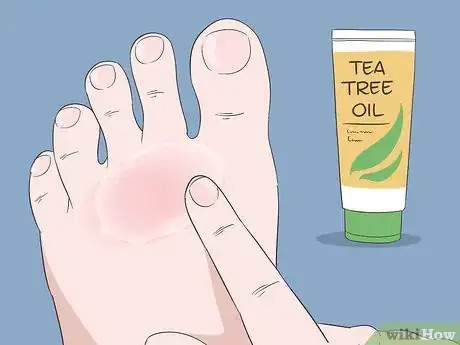 Image intitulée Cure Athlete's Foot Naturally Step 1