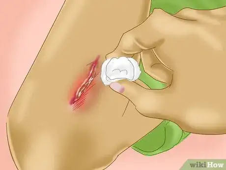Image intitulée Treat a Skin Flap or Abrasion During First Aid Step 3