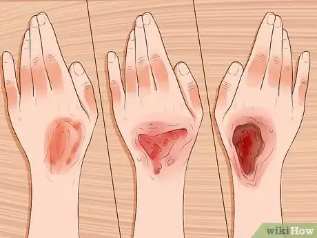 Image intitulée Treat a Facial Burn from a Curling Iron to Prevent Scars Step 2
