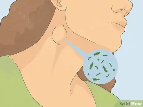 Image intitulée Reduce Lymph Node Swelling Step 8