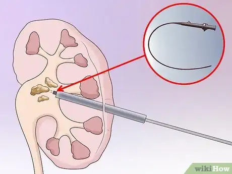 Image intitulée Dissolve Kidney Stones Step 11