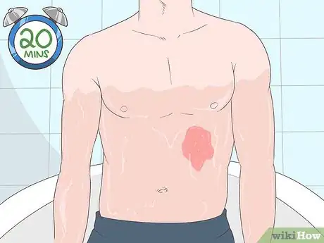Image intitulée Treat an Ice Burn Step 4