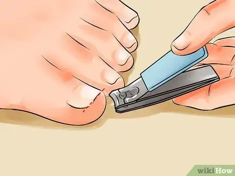 Image intitulée Remove an Ingrown Toenail Step 19