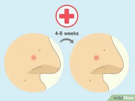 Image intitulée Treat Whiteheads Step 6