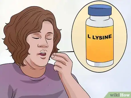 Image intitulée Stop a Cold Sore from Growing Step 6