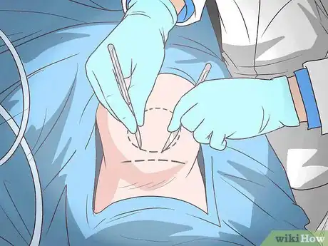 Image intitulée Fix Hyperextended Knees Step 3