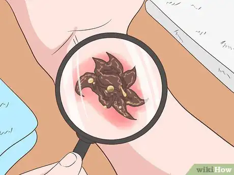 Image intitulée Treat an Infected Tattoo Step 9