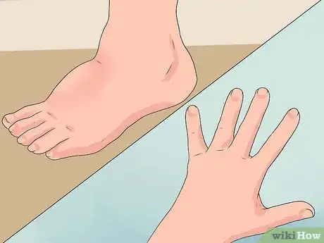 Image intitulée Reduce Edema Naturally Step 1