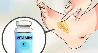 retirer ses points de suture