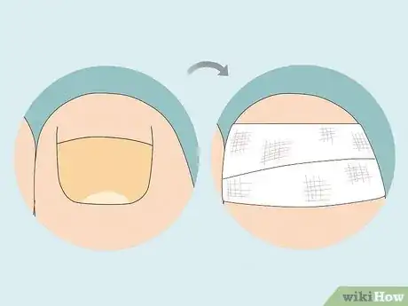 Image intitulée Remove a Dead Toenail Step 10
