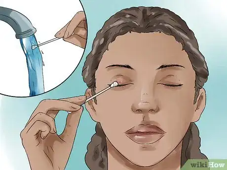 Image intitulée Get Rid of a Stye Step 1