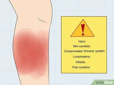 Image intitulée Treat Cellulitis Step 1