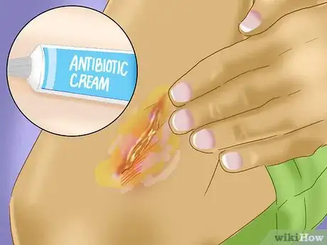 Image intitulée Treat a Skin Flap or Abrasion During First Aid Step 6