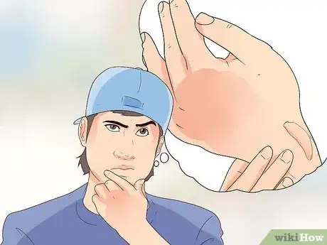 Image intitulée Heal a Keloid Step 14