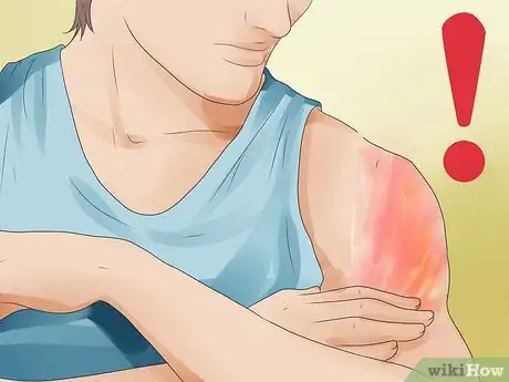Image intitulée Treat Carpet Burns Step 16