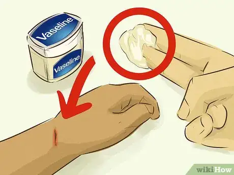 Image intitulée Stop Bleeding Step 2